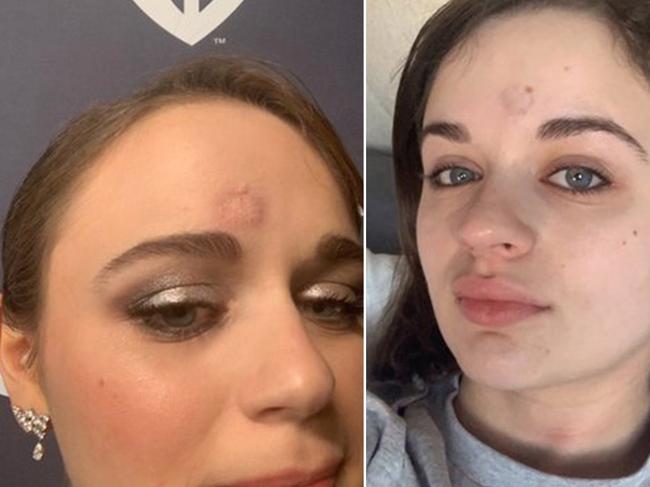 Joey King shows off her bruise from Patricia Arquette's Golden Globe trophy.