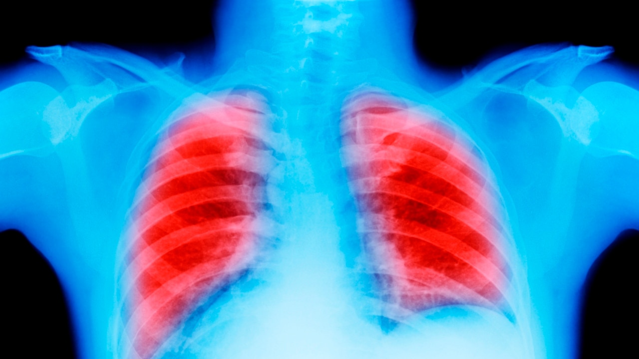 Rise in lung cancer among non-smokers