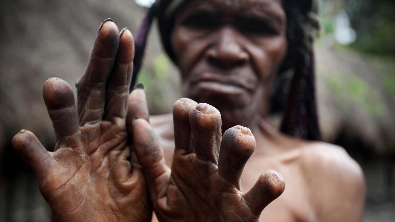 Indonesian Tribes Inside The Dani Tribe Finger Amputation Rituals