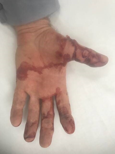 ERGON: Photo of an Ergon Energy meter reader's injuries after an incident in Barcaldine recently.