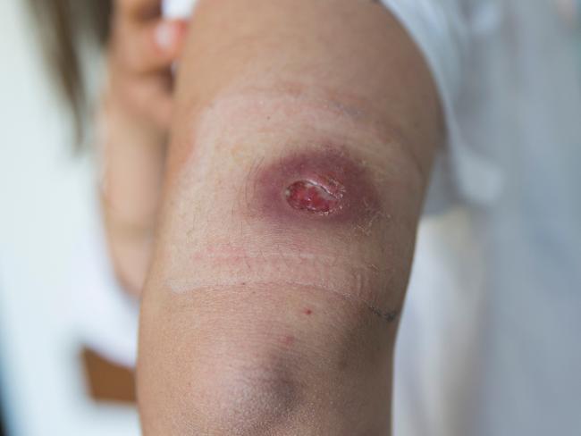 Bianca Ludowyke and 1-year-old baby Isla, who were infected with Buruli Ulcers.The Mornington Peninsula continues to be affected by the spread of the mysterious Buruli Ulcer, with infected patients continuing to be reported with greater numbers than the year before.Photo by Paul JeffersThe Australian11 Oct 2018