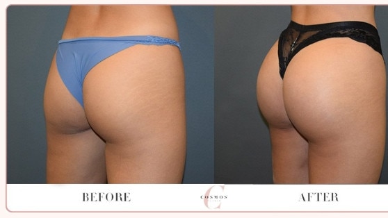 Before and after Brazilian butt lift photos on the Cosmos Clinic website. Picture: Supplied