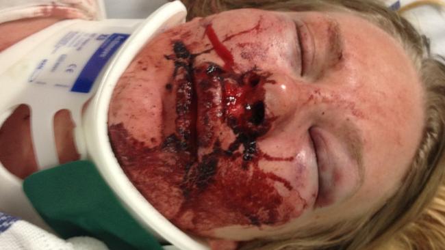 Chloe was so badly beaten the police detective didn’t recognise her at the hospital. Picture: Victoria Police