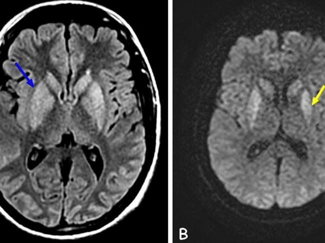 The effects of cocaine use on the brain. Figure 1: Brain MRI showing bilateral and symmetrical T2 and FLAIR (A) hyperintensity of the basal ganglia with diffusion restriction (B and C). Blue arrow: T2 FLAIR hyperintensity of the basal ganglia. Yellow arrows: DWI hyperintensity of the basal ganglia.