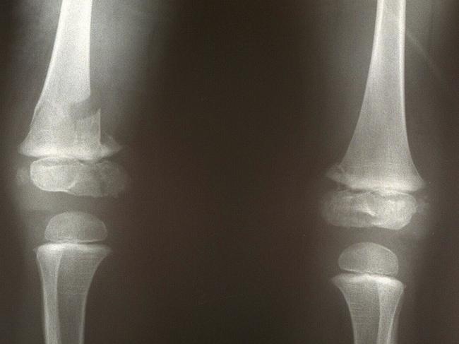 X-rays show sustained fractures in bilateral femur bones in both of Oscar's legs after his fall.