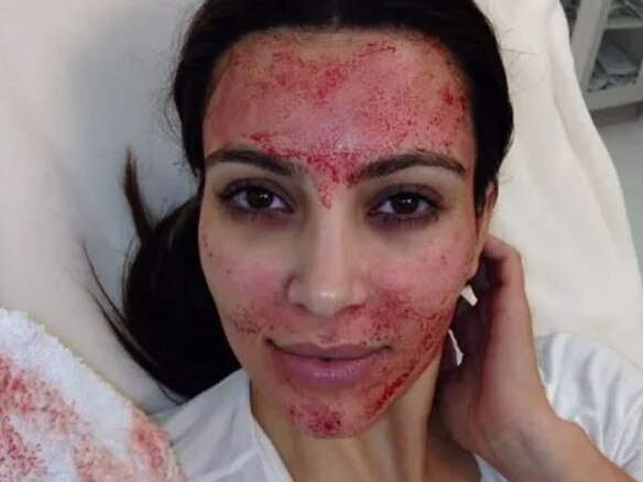The procedure was made popular by Kim Kardashian. Picture: Instagram