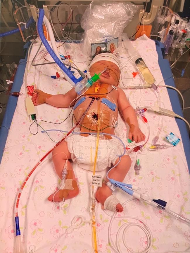 Azaria had her first open-heart surgery at six days old, and another at four months.