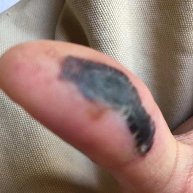 Ms Corby's thumb after she was bitten by a snake in 2018.