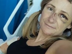 Bridget Harvey seriously injured her leg after her moped crashed into a bus on Magnetic Island on June 7. Picture: GoFundMe