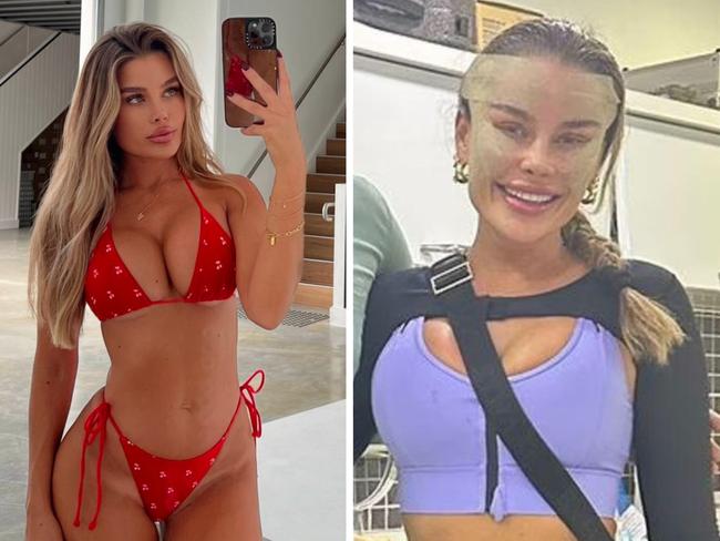 Skye Wheatley has shut down speculation that the reason she hasn’t shown the results of her recent cosmetic surgery is because she regrets it. Picture: Instagram