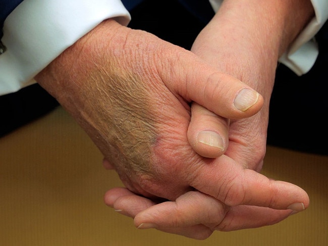 Makeup attempts to cover a bruise on the back of U.S. President Donald Trump's hand, which the White House has explained as being caused by “shaking hands every day”. Picture: Chip Somodevilla/Getty Images