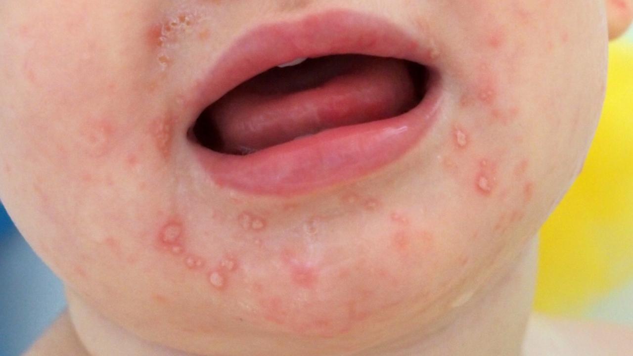 Top End alert for Hand, Foot and Mouth virus in childcare centres ...