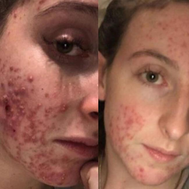 People have been sharing their impressive skincare results using the original cream online. Picture: Instagram / Nourishing Lively