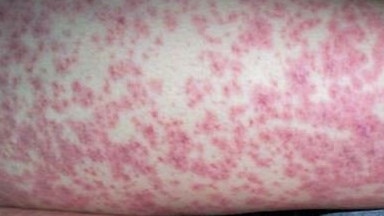 The rash produced by meningococcal disease.