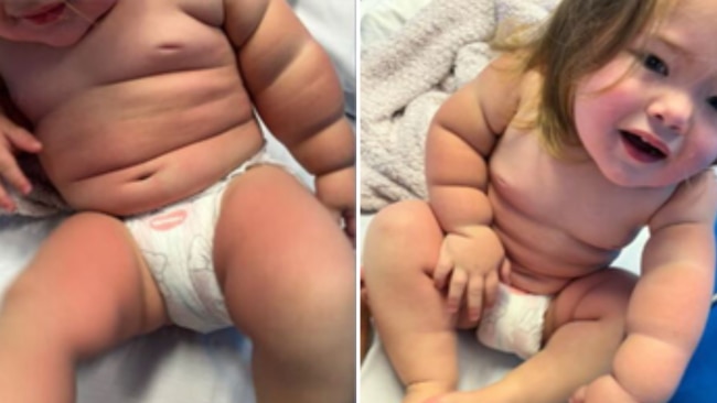 Her toddler suffered first-degree burns and her legs are now peeling. Image: TODAY