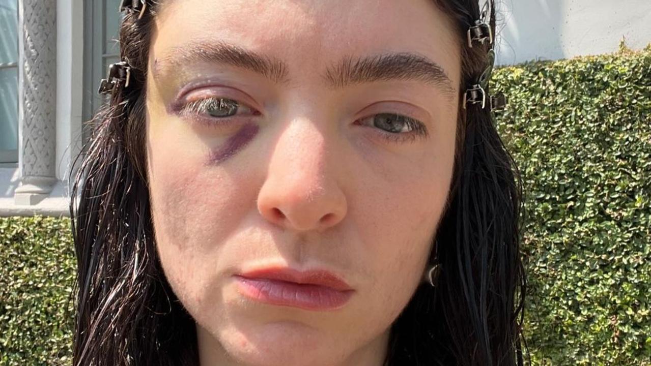 Lorde shares cryptic post with several photos of her black eye