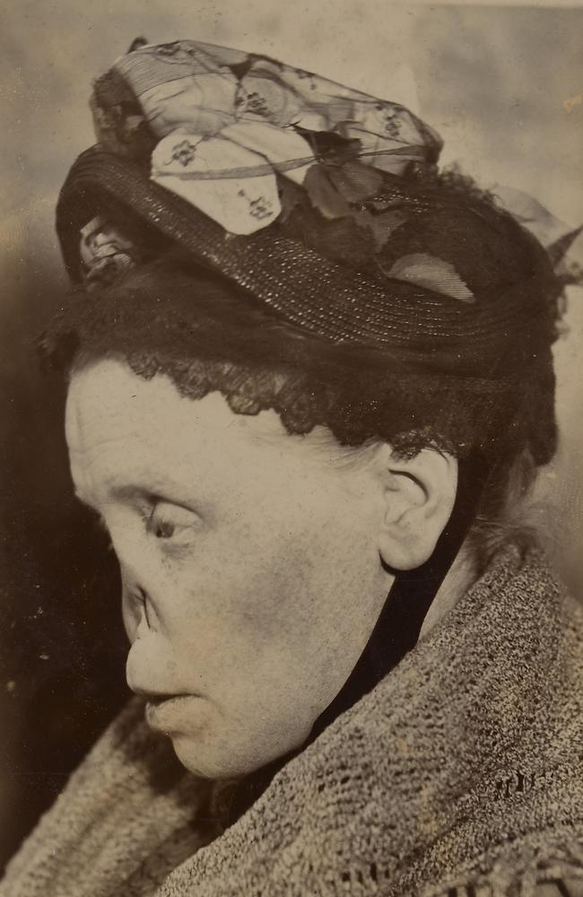 Face of a woman with a typical ‘syphilitic nose'. Picture: St Bartholomew's Hospital Archives &amp; Museum, Wellcome Images