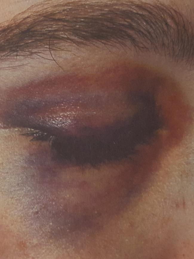 Bruising and facial injuries. Picture: SA Police