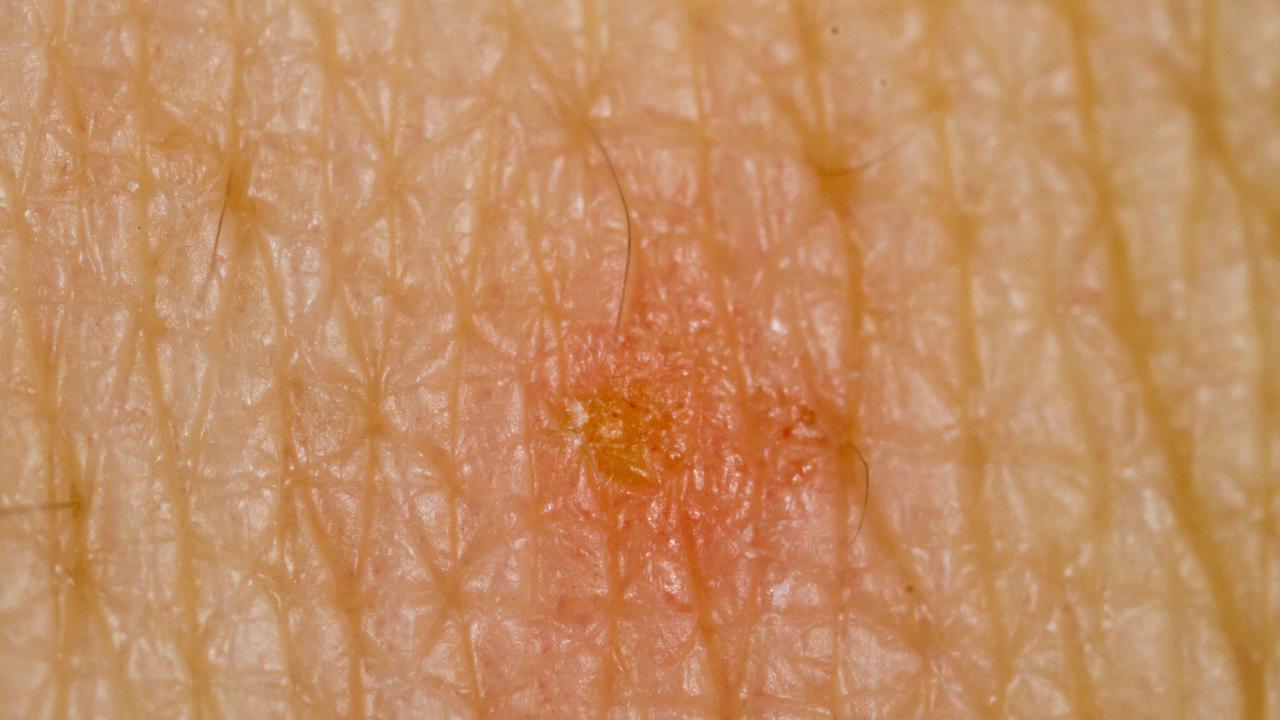 An example of scabies infected skin. Picture: NSW Health