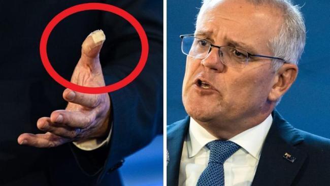 Mystery of ScoMo’s injured thumb