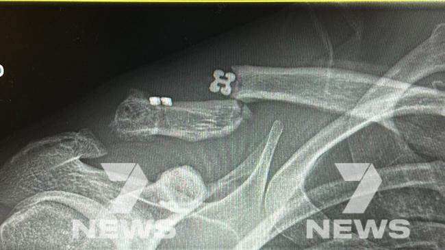 X-Ray scans of Jack Steele's broken collarbone. Picture: Mitch Cleary, Twitter