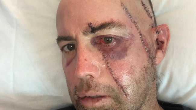 Gold Coast father Andrew was holidaying at Seaforth when he fell overboard and was struck in the face by a boat propeller.