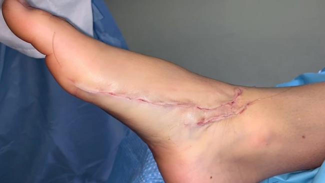 Jackson was bitten twice on the foot by a bronze whaler shark. Picture: Supplied ABC