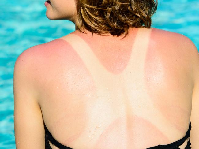 A halter neck bikini tan line is being viewed as a summer accessory rather than a potential precursor to skin cancer. Picture: Supplied