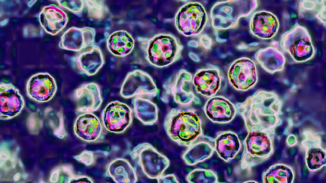 The measles virus can cause serious health complications. Picture: BSIP/Universal Images Group via Getty Images