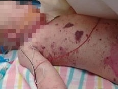 FB pic of the meningococcal baby, posted by who we beleive is the grandmother , Bianca Bais .  16-month-old named Charlie, in WCH.