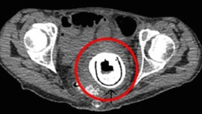 Surgeons remove toy stuck in woman s vagina for 10 years news