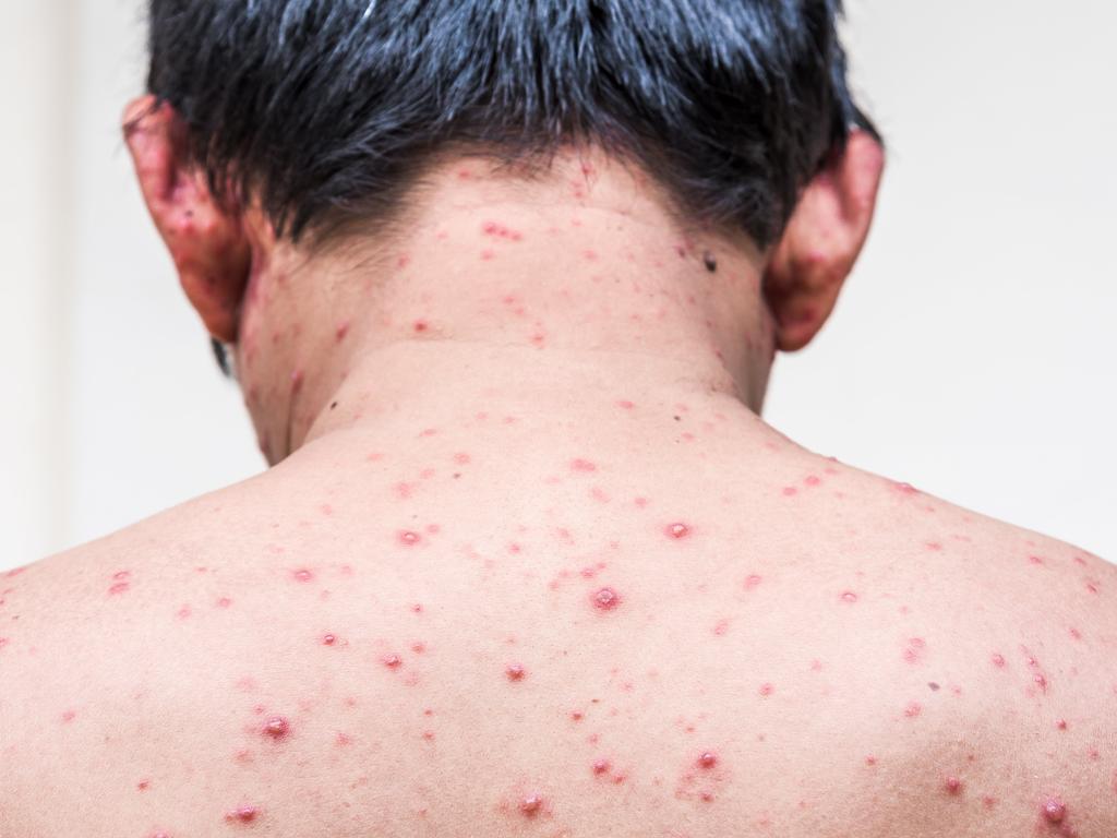 Safer and more effective shingles vaccine will be available to Aussies ...