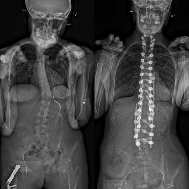 Annaliese Holland’s before and after life saving spinal surgery from the front. Picture: Supplied