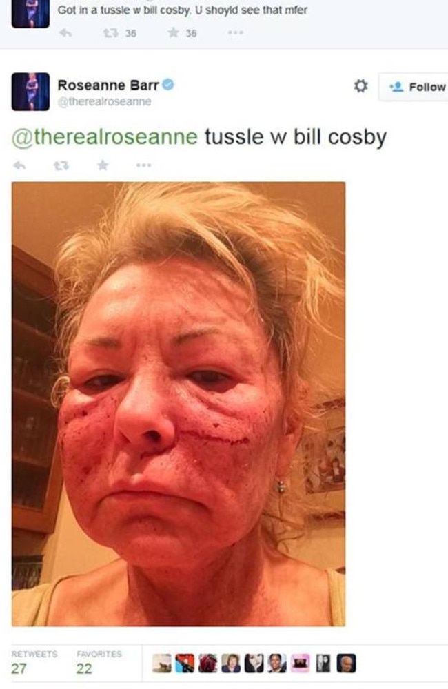 Roseanne said her battered face was a result of a 'tussle with Cosby.'