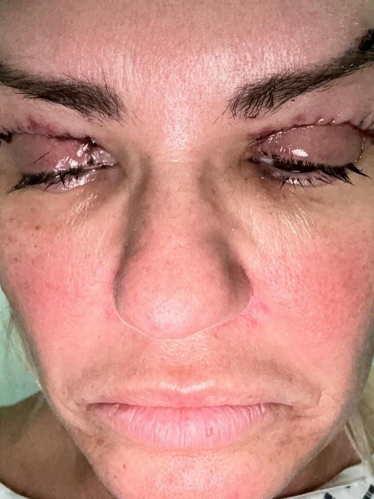 Katona shared this photo immediately after the surgery. Picture: BACKGRID