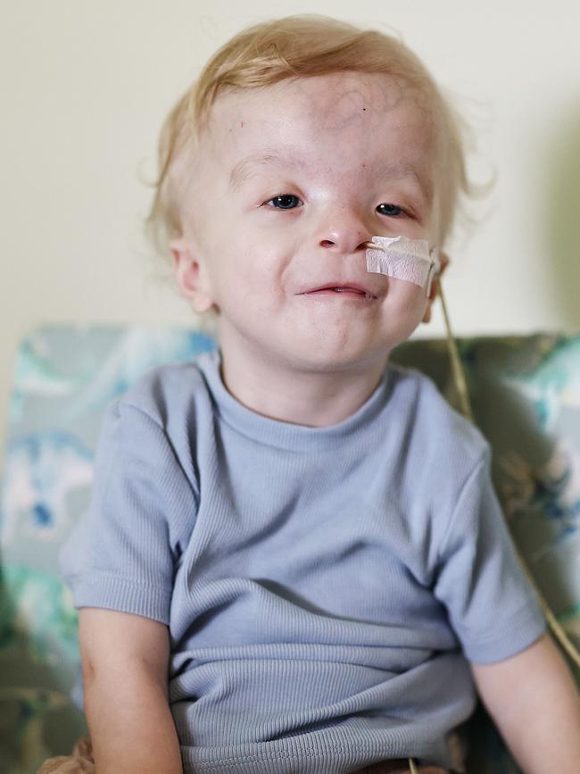 Toddler Colton Hughes-Hodges was born with the heart defect Tetralogy of Fallot, congenital heart defect, which left a hole in his heart along with narrowed valves and arteries. Picture: Brendan Radke
