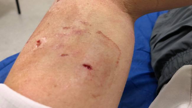 A bite mark left on Lucy Friend's arm. Picture: Lucy Friend.