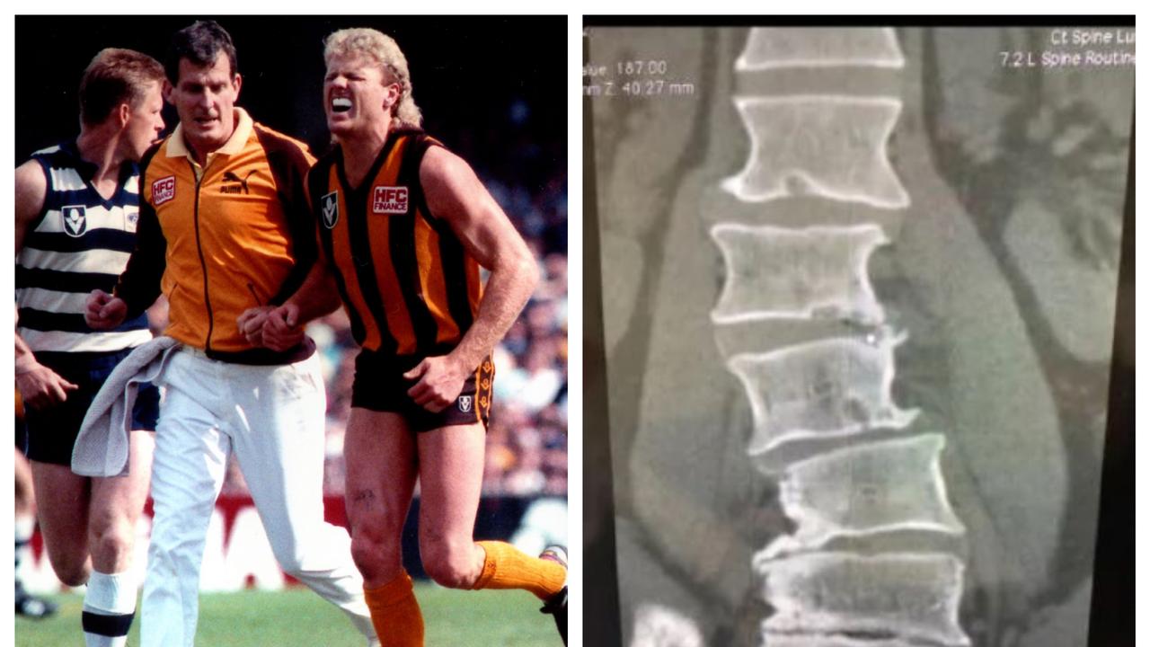 Dermott Brereton and the extent of his football injuries.