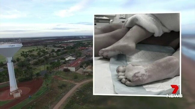 WA father’s plea after campfire leaves two-year-old with severe burns (7 News)