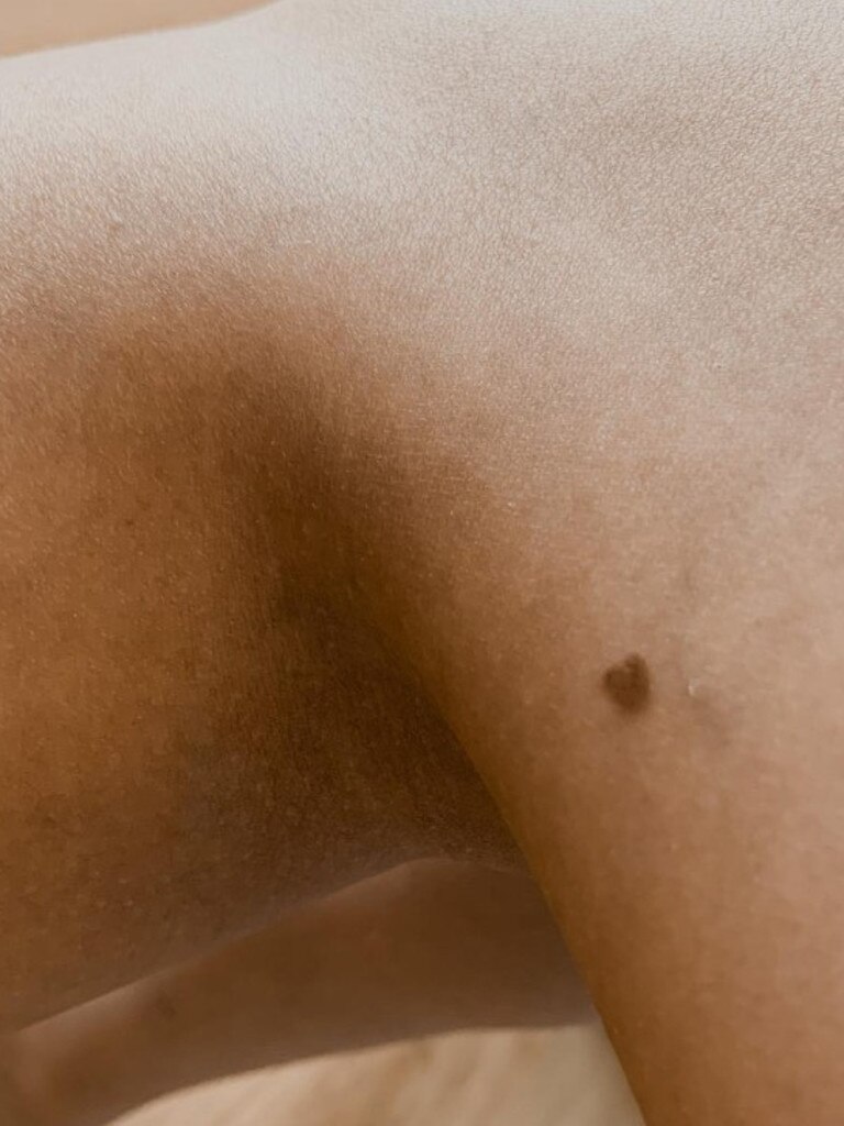 The mole was melanoma. Picture: Instagram