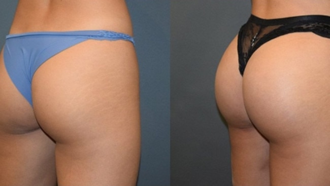 Dangerous or Life Changing? —A Deep Dive into Brazilian Butt Lift Procedure