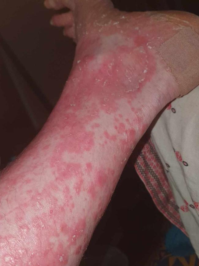 Margie Babia Sézary syndrome rash on her leg.