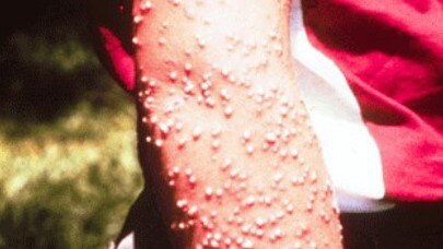 Pustules resulting from fire ant stings. Picture: Murray S. Blum.