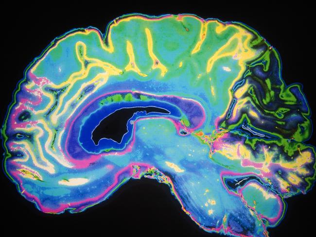 Coloured image of a human brain. Slice of a human brain. stock image. Picture: ThinkStock