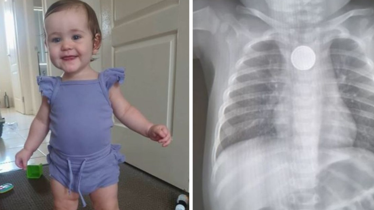 Shocking item lodged in toddler’s throat