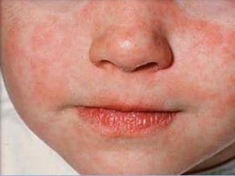 A child with measles. Pic: NSW Health