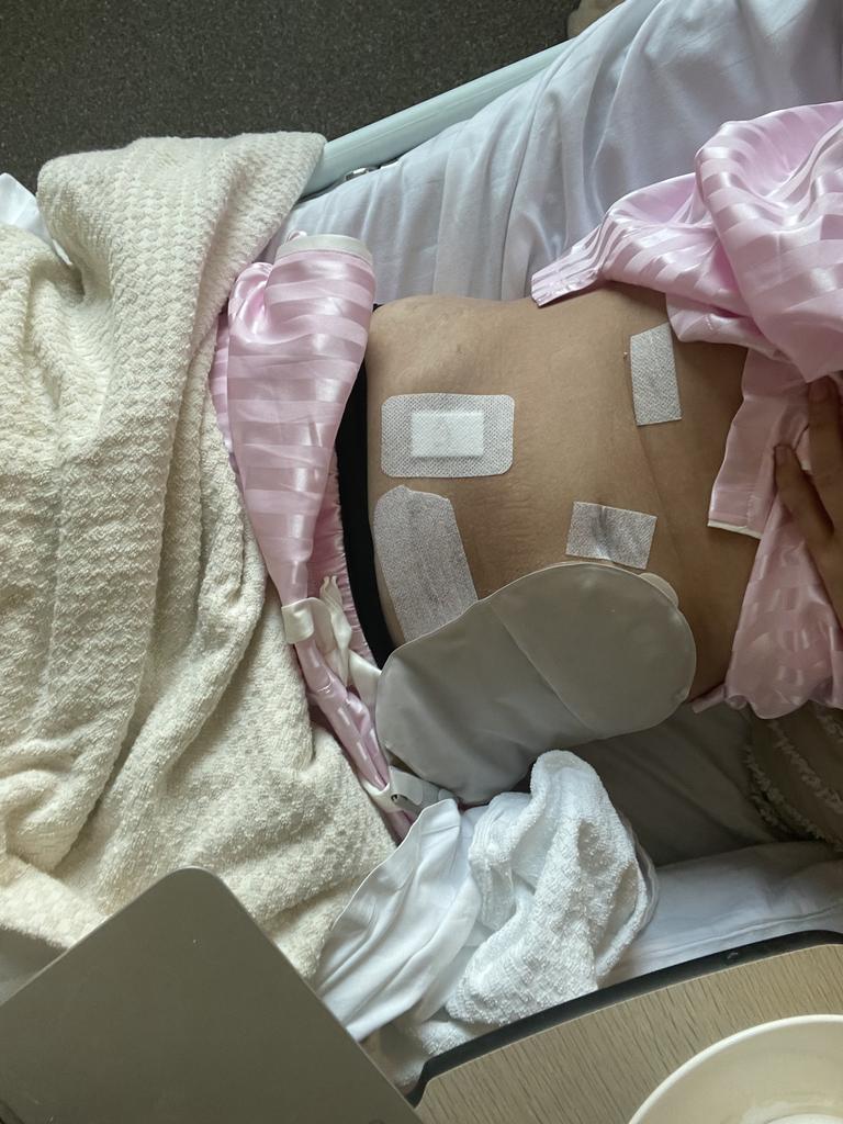 Kellie woke up with a colostomy bag after her surgery. Picture: Supplied