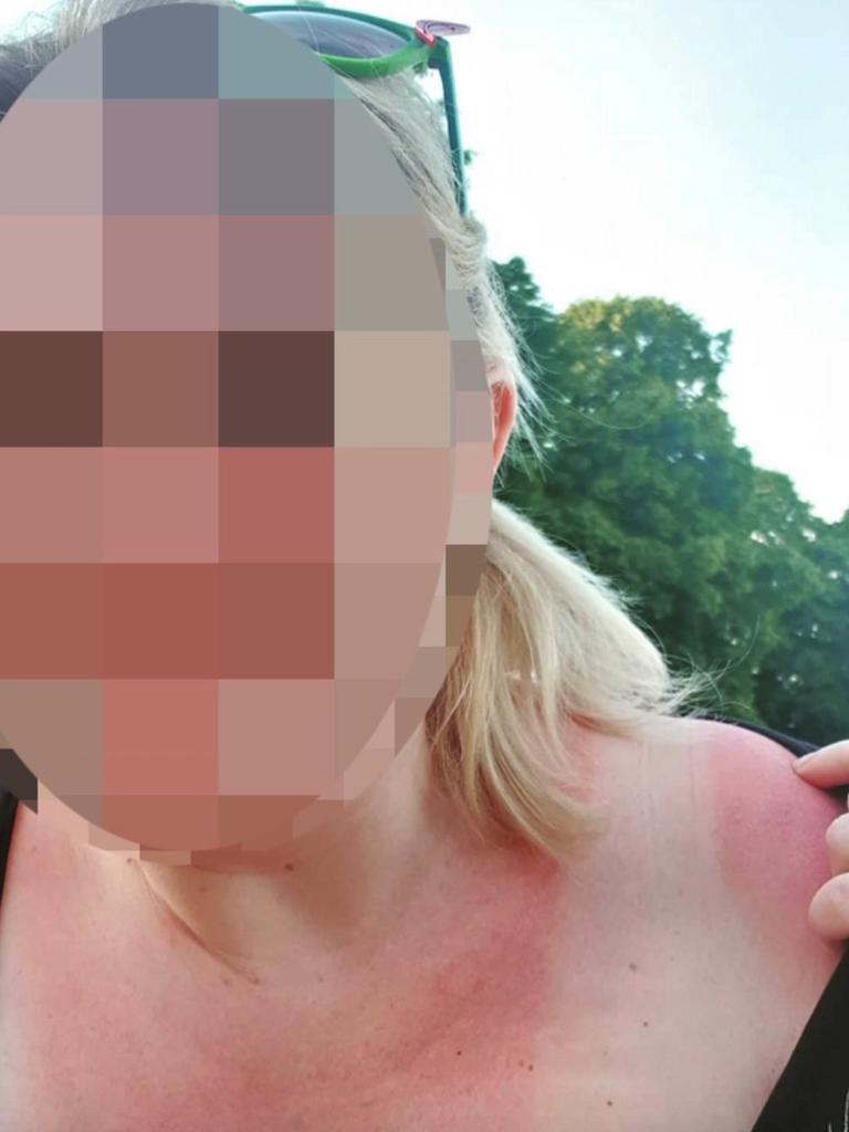 This woman posted a sunburnt selfie on Instagram. Picture: Instagram