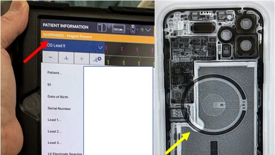 A device programmer shows the suspension of ICD therapies (orange bar, red arrow) with iPhone 12 laying over a patient’s chest (green arrow) and the fluoroscopy of iPhone 12 showing the circular magnet array (yellow arrow). Picture: Heart Rhythm Society