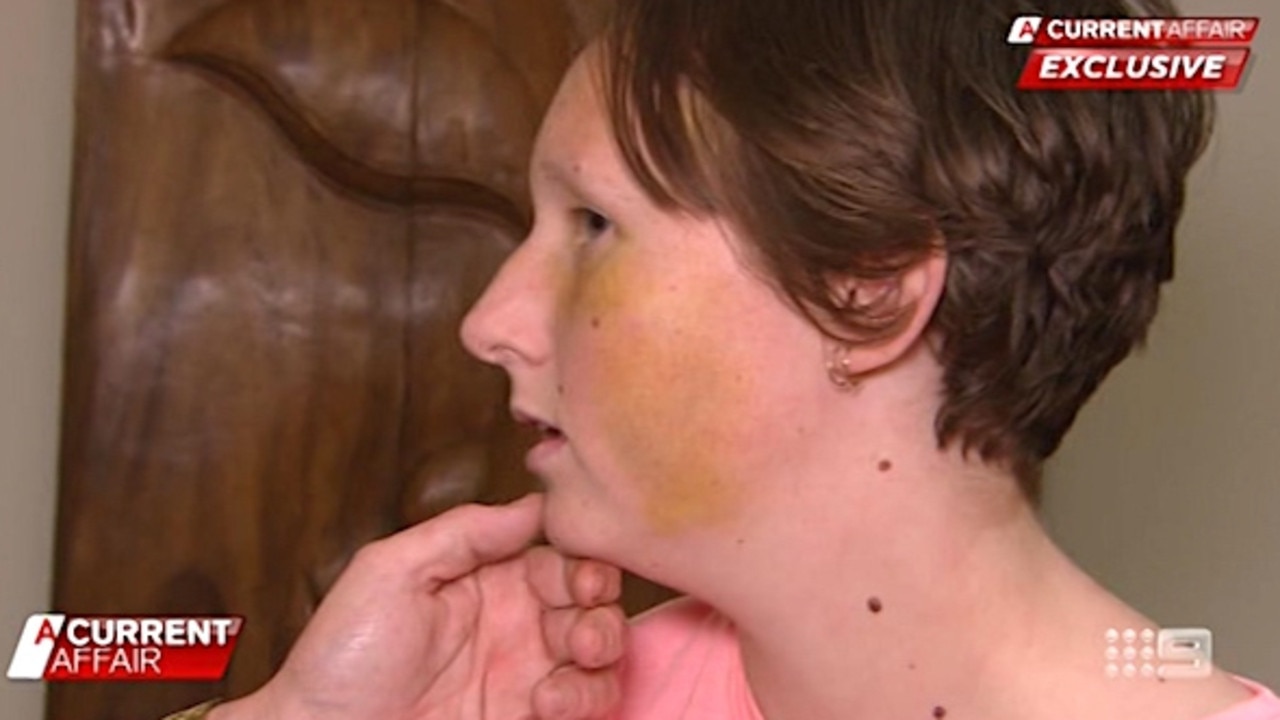 Kayla Kendrigan is recovering from the alleged attack. Picture: ACA